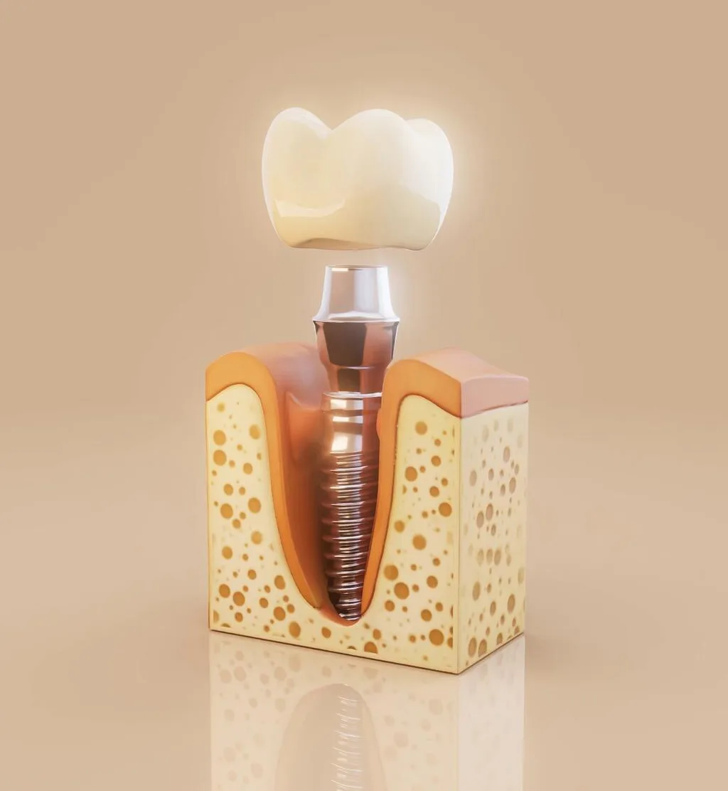 Implant Surgery and Restoration