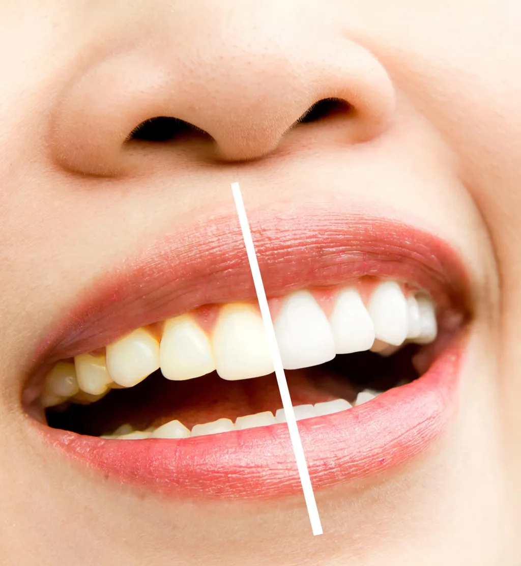 Zoom Whitening