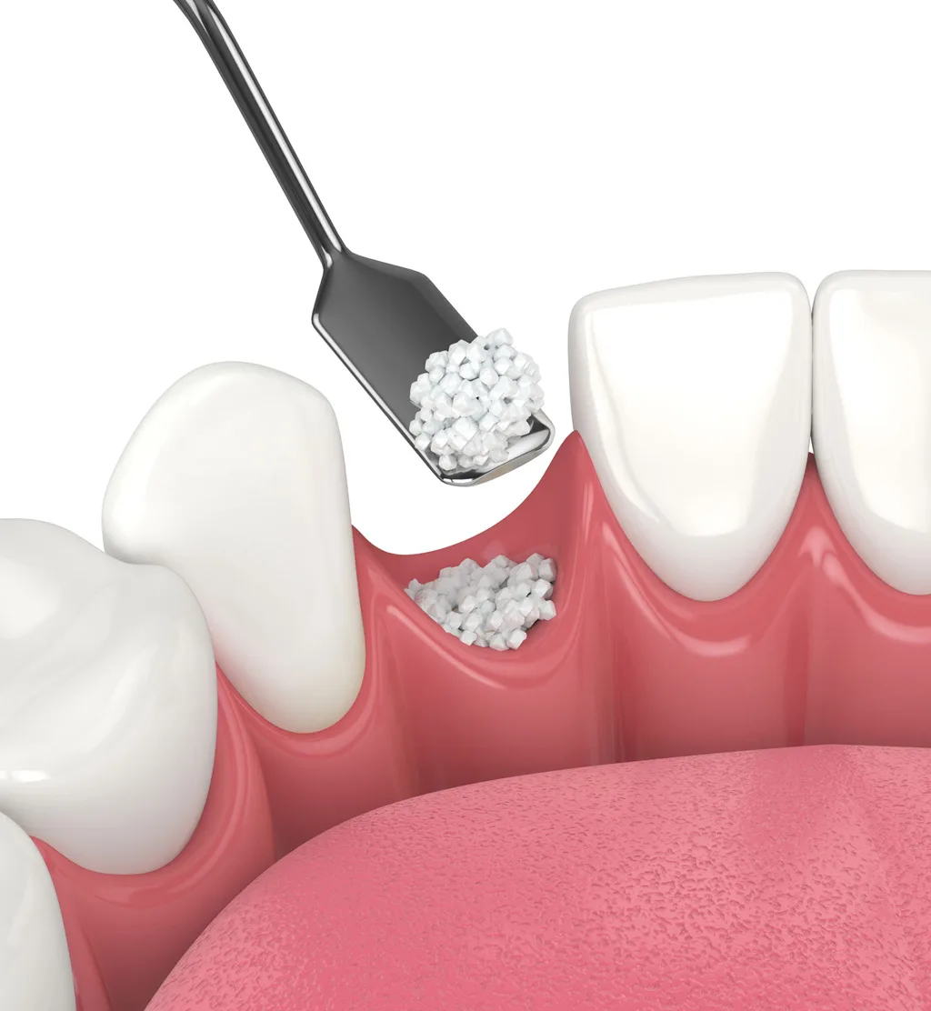 Bone Grafting & Tissue Grafting