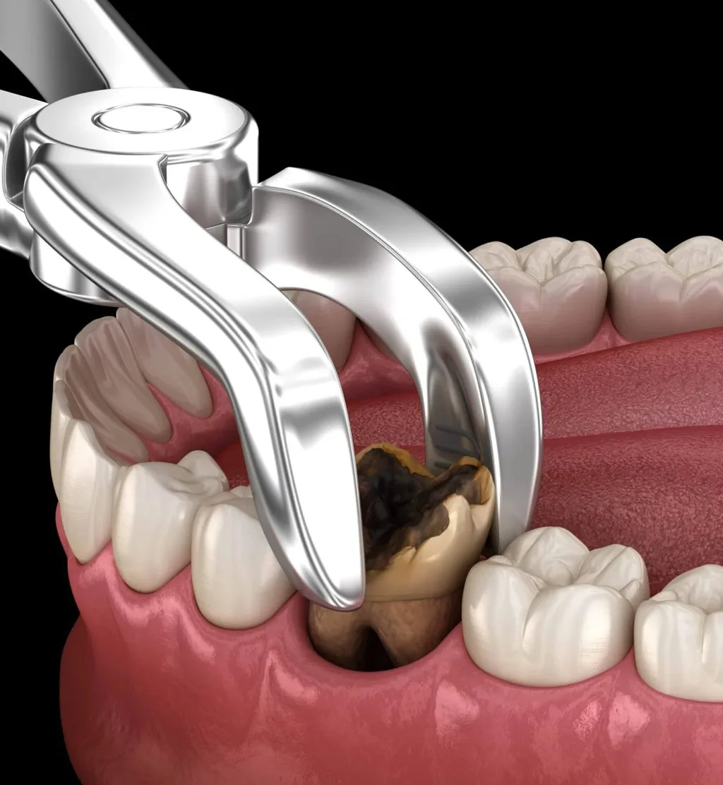 Difficult Tooth Removal