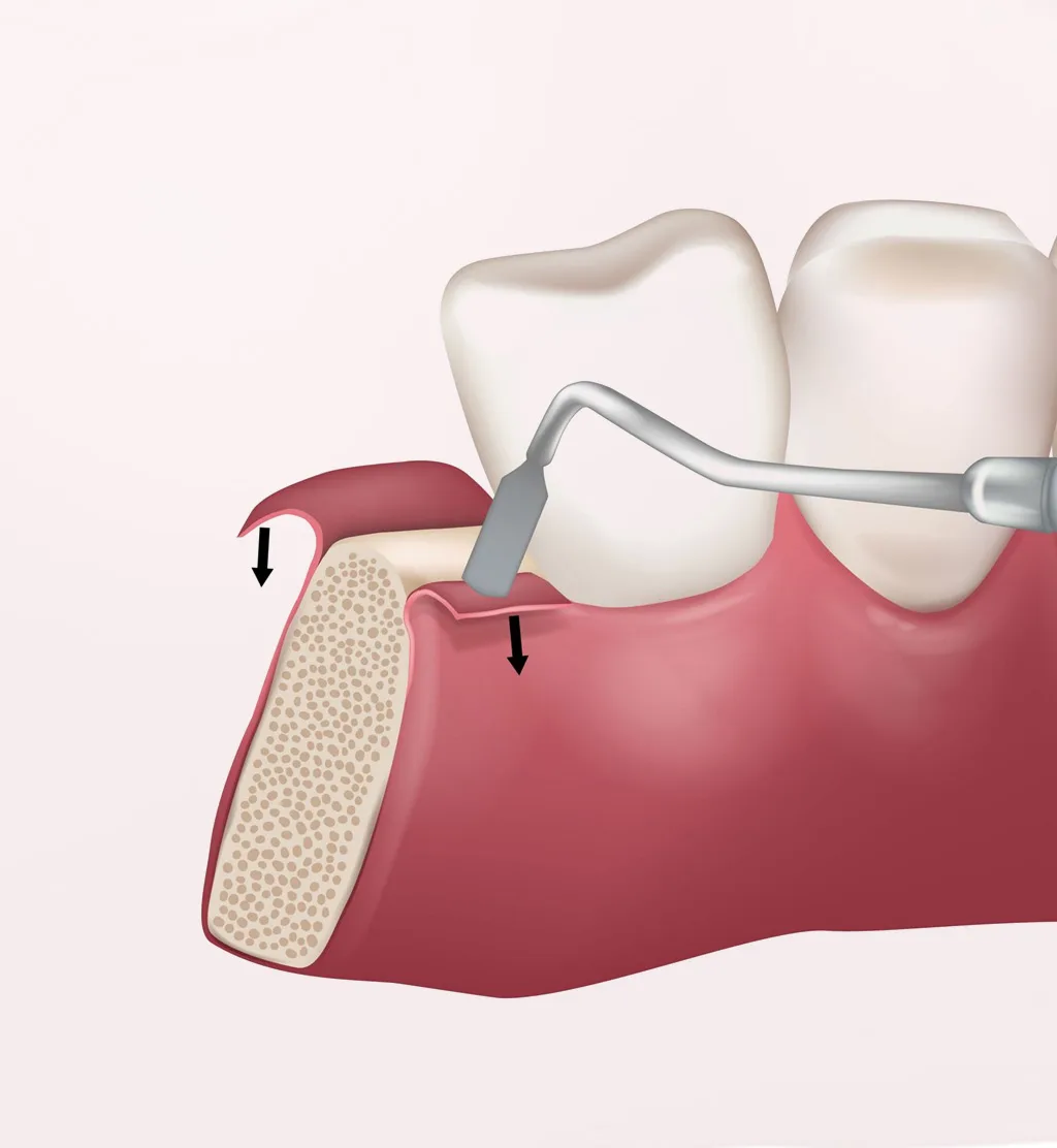 Flap Surgery