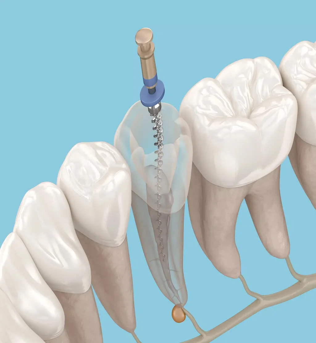 Non-Surgical Root Canal Treatments