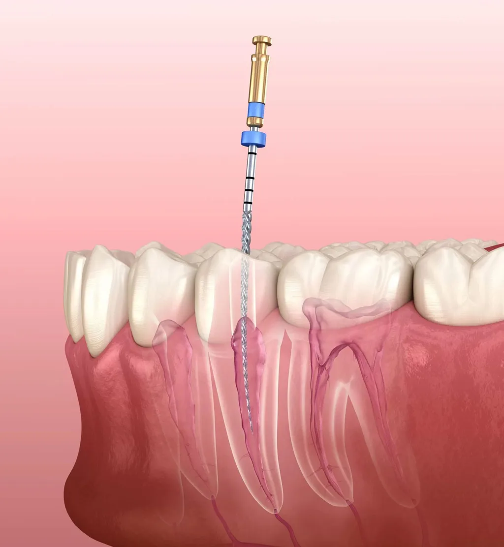 Repeat Root Canal Treatments